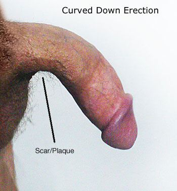 Scars On Penis 104