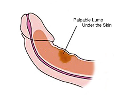 Lump On Penis When Erect 59