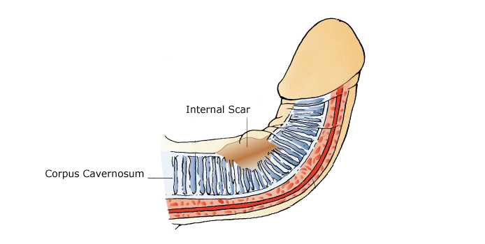 Fixing Curved Penis 44