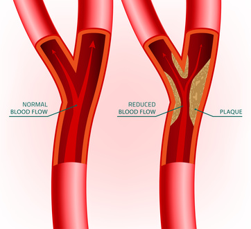 natural treatment for erectile dysfunction caused by arteriosclerosis