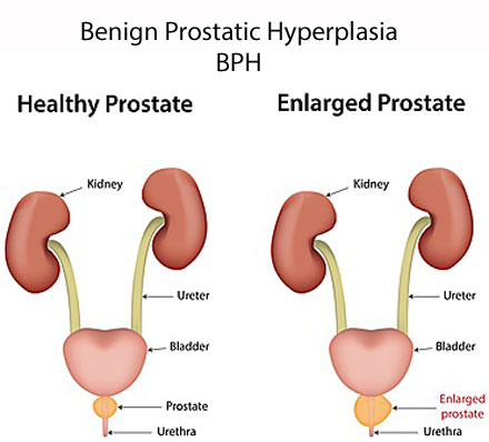 prostate problems and BPH benign prostatic hyperplasia
