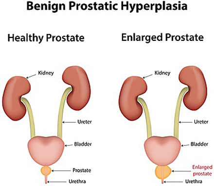 benign prostatic hyperplasia, BPH