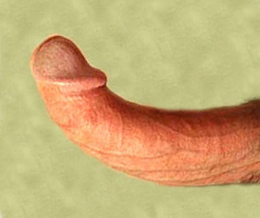 erectile dysfunction symptoms and a peyronies disease bent penis