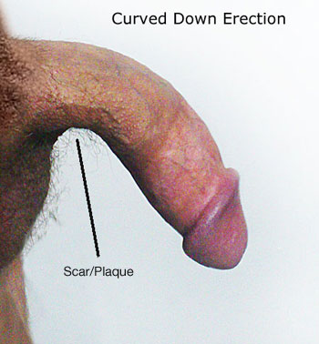 bent penis cure for scar or plaque