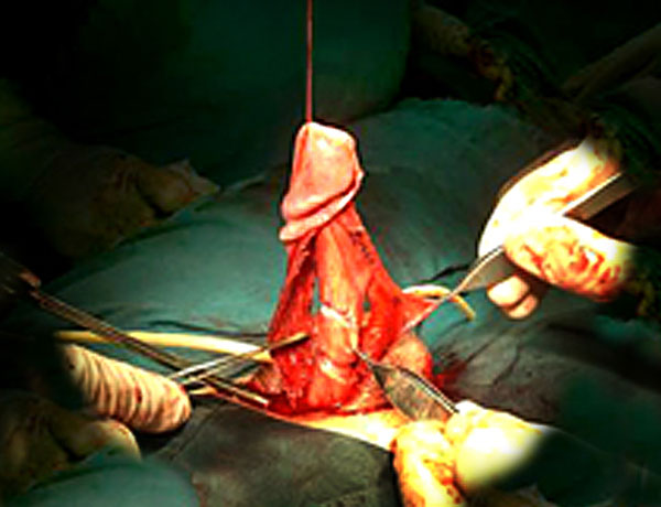 penis surgery