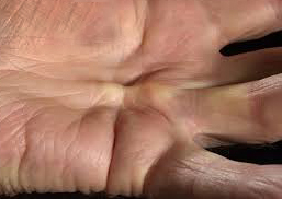 dupuytrens contracture 1
