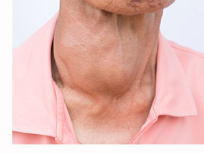 goiter and BPH benign prostatic hyperplasia