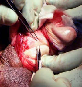peyronies disease surgery can cause erectile dysfunction