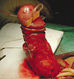 penis curvature surgery