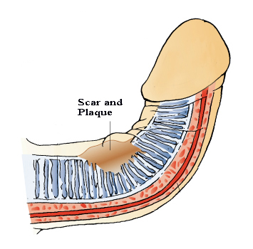 peyronies disease causes and treatments
