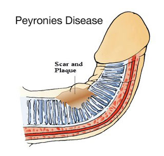 what is peyronies disease?