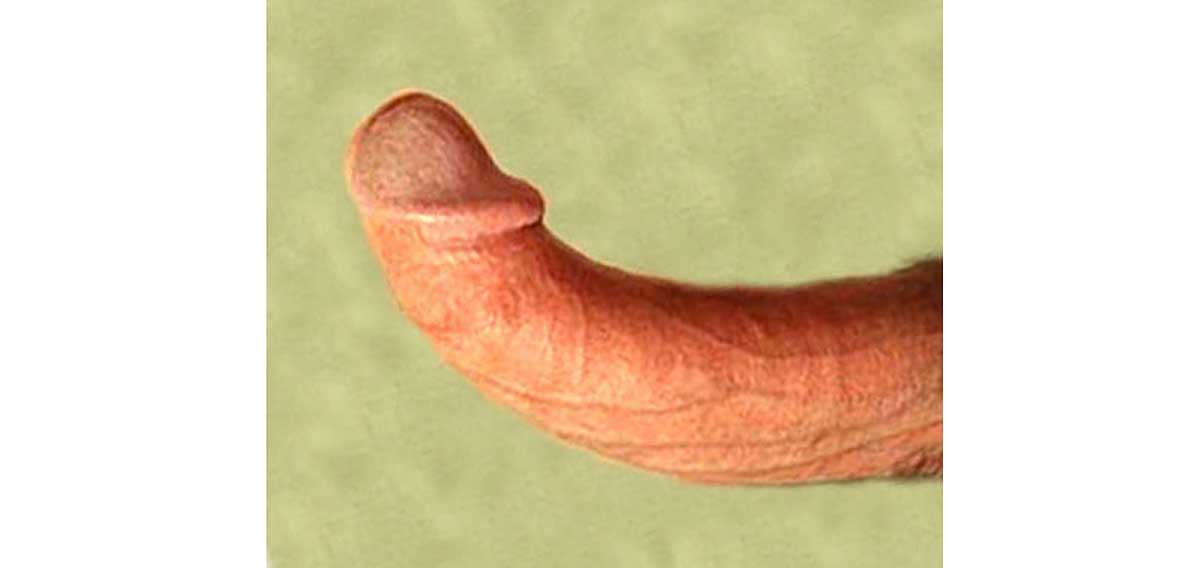 penis curvature caused by peyronies disease