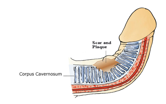 peyronies is caused by a simple scars you can not see
