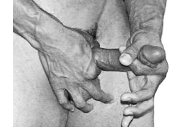 jelqing for a bent penis caused by Peyronies disease