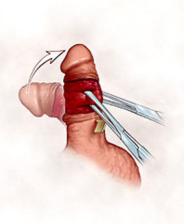 nesbit procedure penis surgery