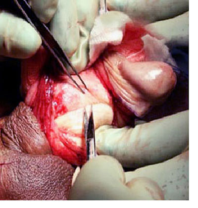 penis surgery for curvature of the penis