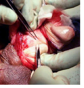 peyronies disease surgery