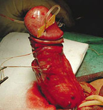 penis surgery as peyronies treatment