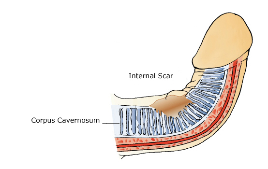 corpus cavernosum causing peyronies disease
