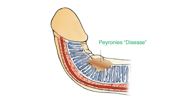 Peyronies disease and penis stretching