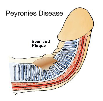 what is Peyronies disease?