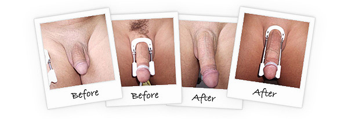 natural male enhancement with penis traction